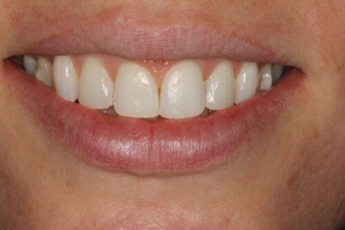 After cosmetic bonding 2022 05 16 103913 uyds