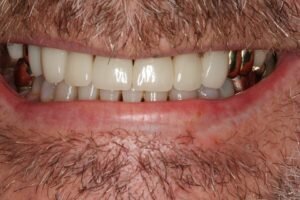 After cosmetic dentistry 300x200
