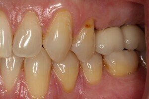After implants 1 300x200