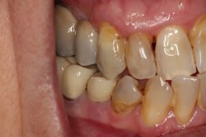 After implants 300x200