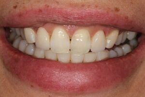 After laser gum treatment 300x200