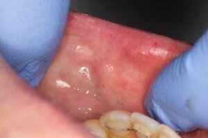 After laser removal 300x200