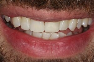 After lingual brace and cosmetic bonding 300x200 3