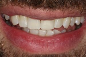 After lingual brace and cosmetic bonding 300x200