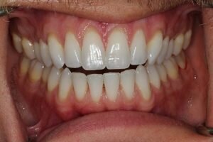 After lingual braces 300x200 7
