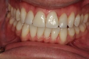 After lingual braces teeth whitening and cosmetic bonding 300x200