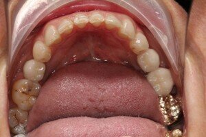 After occlusal 300x200