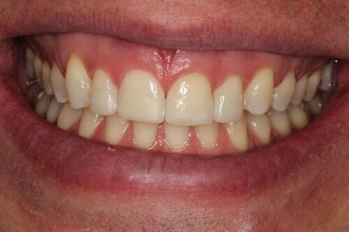 After ortho and bonding