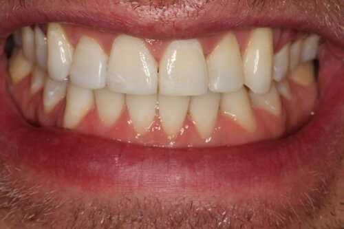 After orthodontics and whitening