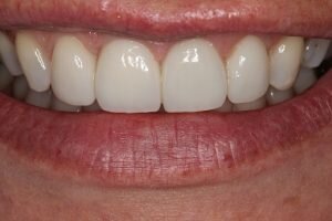 After porcelain veneers 300x200