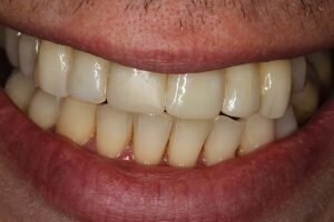 After smile transformation 300x200