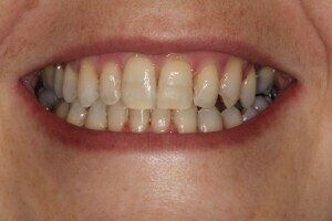 After smiling 300x200ss