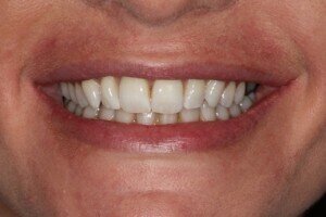 After smiling 300x200tt