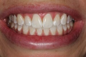 After teeth whitening ZOOM 300x200