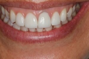After veneers 300x200