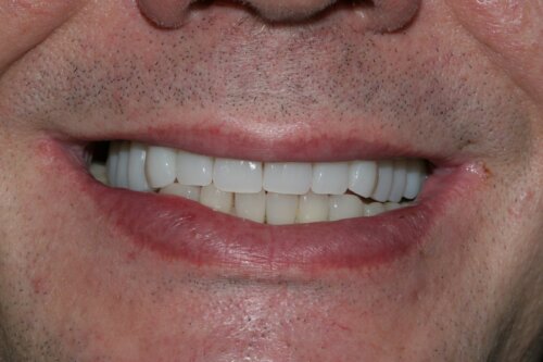 All teeth implants After 5