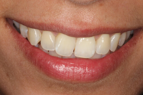 Before Invisalign for rotation