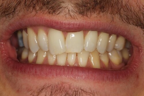 Before Invisalign
