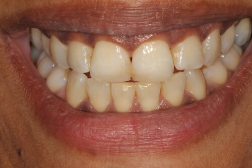 Before Invisalign2