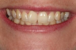 Before Social 6 braces 300x200