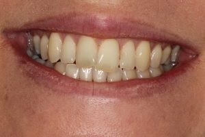 Before Social 6 lingual brace 300x200 2