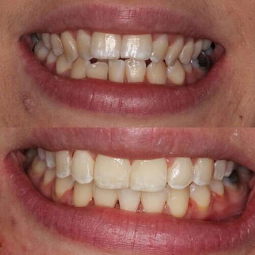 Before and after Invisalign 1024x1024