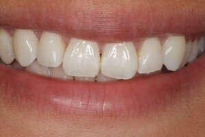 Before bonding 300x200bh