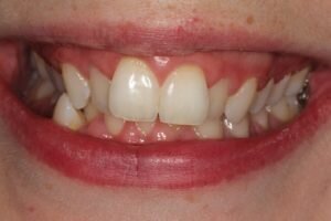 Before ceramic braces 300x200