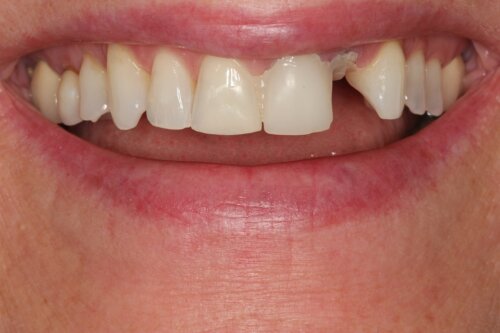 Before ceramic crowns