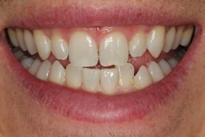 Before cosmetic bonding 300x200 1