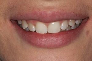 Before cosmetic bonding 300x200 4