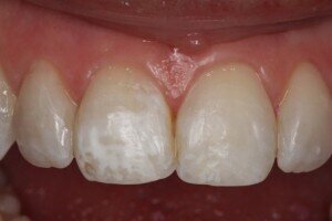 Before cosmetic bonding 300x200dd