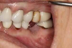 Before dental implant 300x200 01