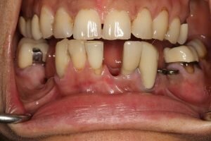 Before dental implant 300x200