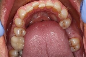 Before dental implant molar 300x200