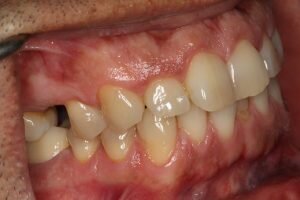 Before dental implant premolar 300x200