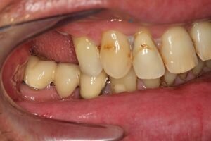 Before dental implants right side 300x200