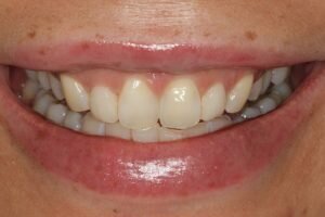 Before laser gum treatment 300x200