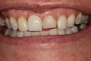 Before porcelain veneers 300x200
