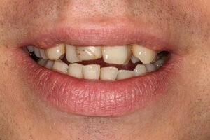 Before smile transformation 300x200