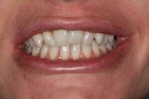 Before smiling 300x200tt