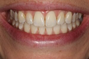 Before teeth whitening 300x200