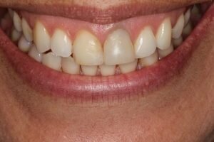 Before veneers 300x200