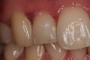 Before1 300x200er