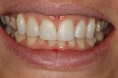Cosmetic bonding after 12