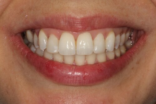 Cosmetic bonding after 14