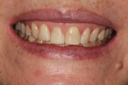 Cosmetic bonding after 18