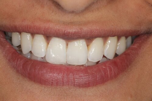 Cosmetic bonding after 20