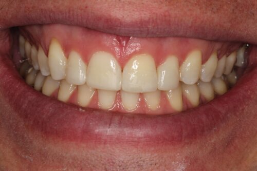 Cosmetic bonding after 4