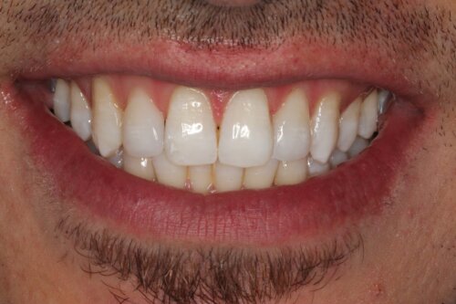Cosmetic bonding after 6